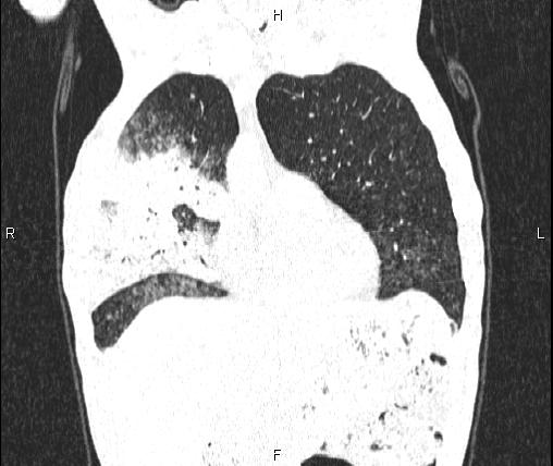 Air bronchogram in pneumonia (Radiopaedia 85719-101512 Coronal lung window 16).jpg