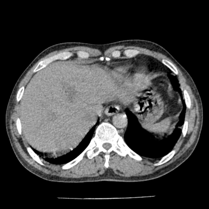 Airway foreign body in adult (Radiopaedia 85907-101779 Axial liver window 170).jpg