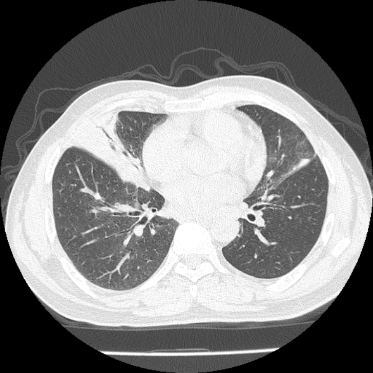 Airway foreign body in adult (Radiopaedia 85907-101779 Axial lung window 110).jpg