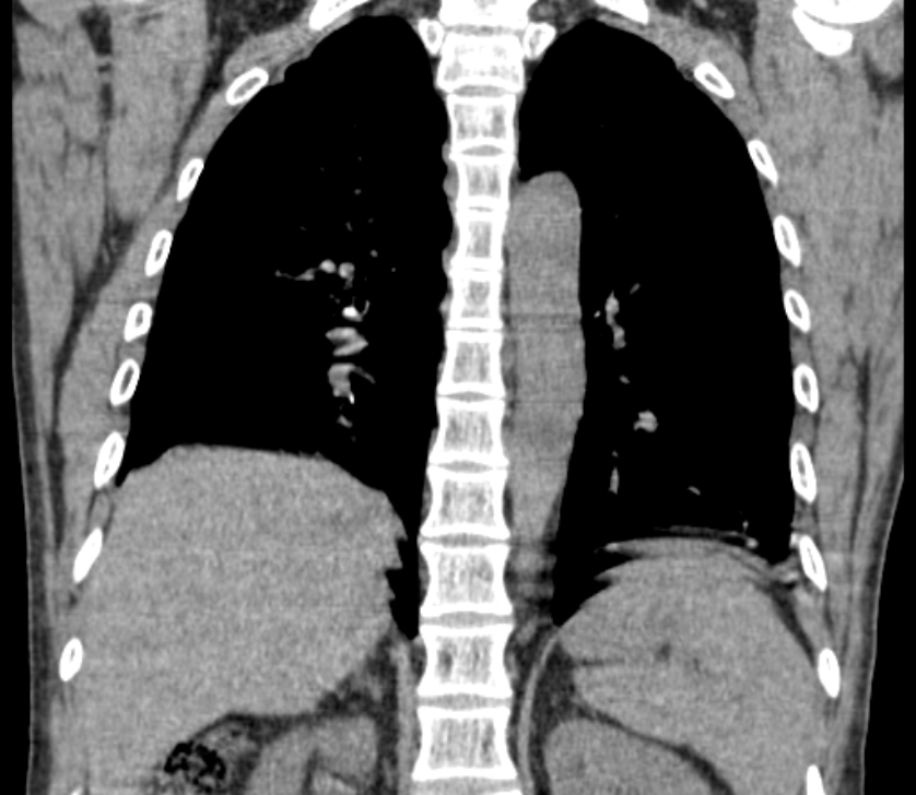 Airway foreign body in adult (Radiopaedia 85907-101779 Coronal liver window 182).jpg