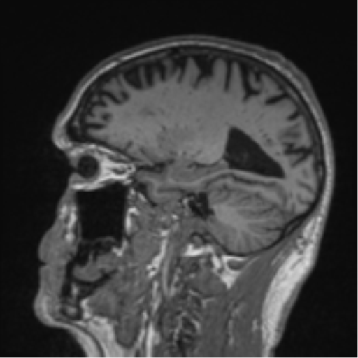 Alzheimer's disease- with Gerstmann syndrome and dressing apraxia (Radiopaedia 54882-61150 Sagittal T1 22).png