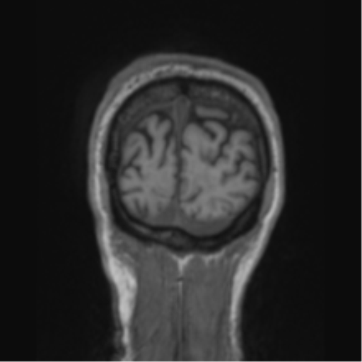 File:Alzheimer's disease- with apraxia (Radiopaedia 54763-61011 Coronal T1 13).png