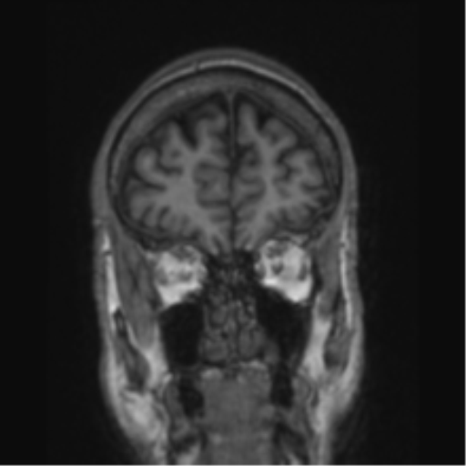 File:Alzheimer's disease- with apraxia (Radiopaedia 54763-61011 Coronal T1 76).png
