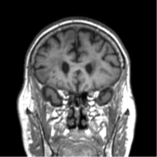 Alzheimer disease and cerebral amyloid angiopathy (Radiopaedia 64234-73011 Coronal T1 51).png