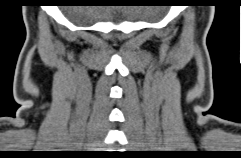 File:Ameloblastoma (Radiopaedia 33677-34806 Coronal non-contrast 58).png
