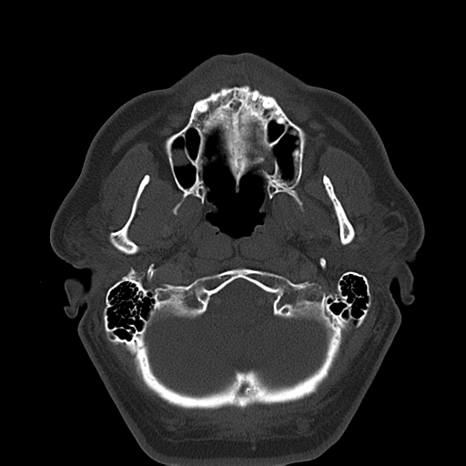 Ameloblastoma (Radiopaedia 38520-40623 Axial bone window 19).png