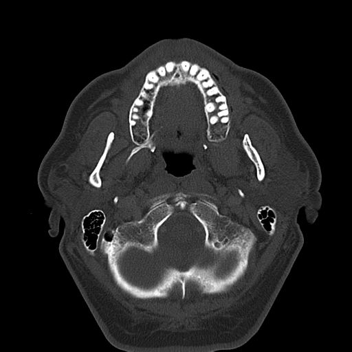 File:Ameloblastoma (Radiopaedia 38520-40623 Axial bone window 21).png