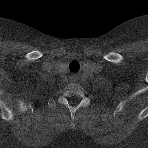 File:Ameloblastoma (Radiopaedia 38520-40623 Axial bone window 65).png