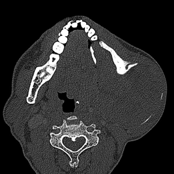 Ameloblastoma (Radiopaedia 51921-57766 Axial bone window 70).jpg