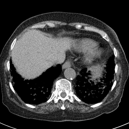 File:Amiodarone-induced pulmonary fibrosis (Radiopaedia 82355-96460 Axial non-contrast 49).jpg