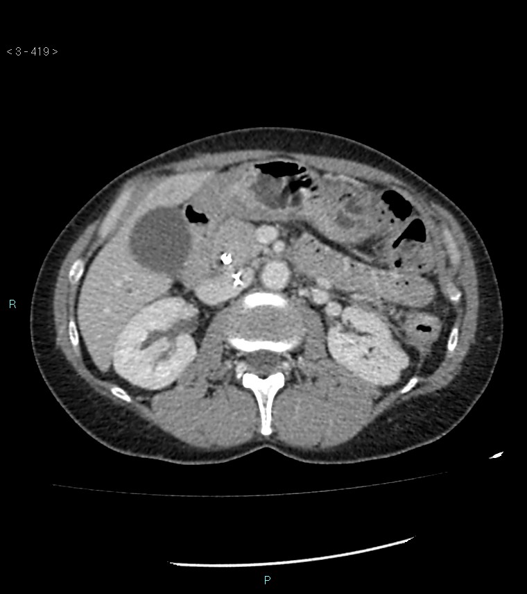 Ampulla of Vater metastasis (Radiopaedia 27820-28069 A 57).jpg