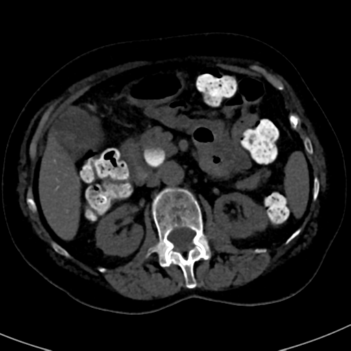 File:Ampullary adenocarcinoma (Radiopaedia 34013-35241 AXIAL THICK 37).png