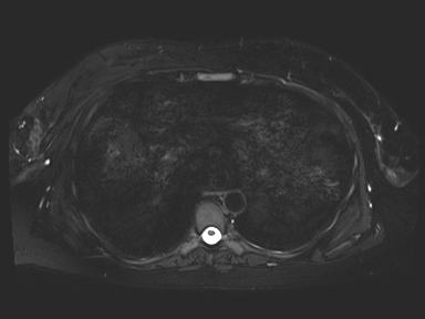 Ampullary adenocarcinoma (Radiopaedia 54765-61014 Axial T2 space-FS 3).jpg