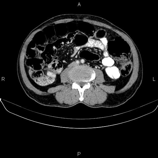 Ampullary adenocarcinoma (Radiopaedia 86093-102032 A 34).jpg
