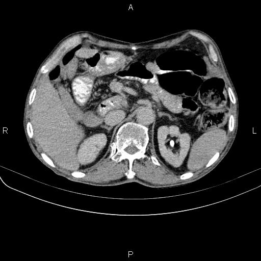 Ampullary adenocarcinoma (Radiopaedia 86093-102033 Axial C+ delayed 37).jpg