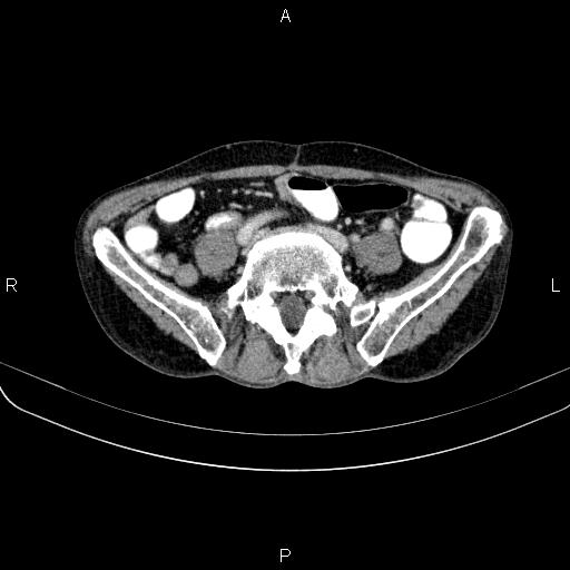 Ampullary adenocarcinoma (Radiopaedia 86093-102033 B 87).jpg