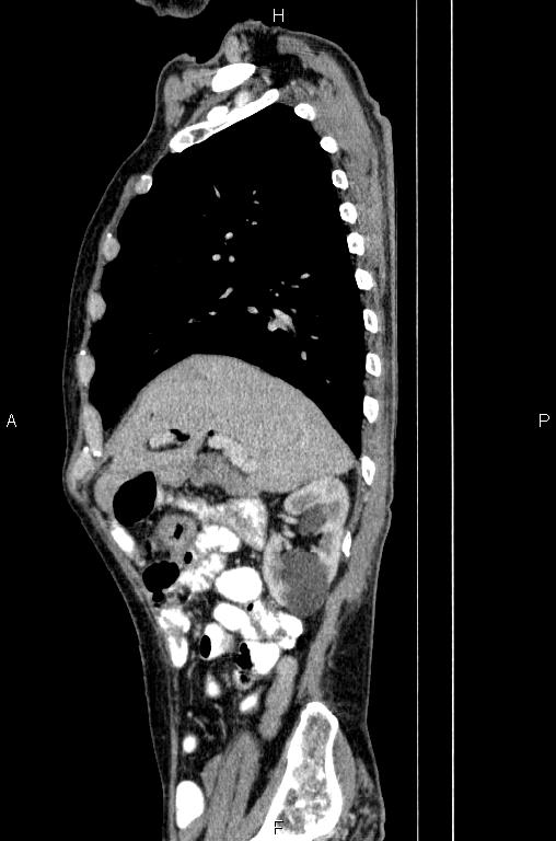 Ampullary adenocarcinoma (Radiopaedia 86093-102033 E 27).jpg