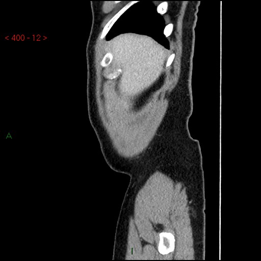 Ampullary carcinoma (Radiopaedia 56396-63056 D 11).jpg