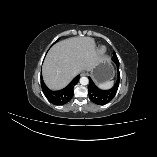 Ampullary tumor (Radiopaedia 60333-67998 A 4).jpg
