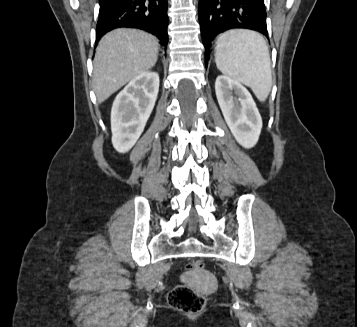 File:Ampullary tumor (Radiopaedia 60333-67998 B 61).jpg