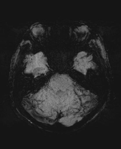 File:Amyloid angiopathy with inflammation (Radiopaedia 30360-31002 Axial SWI MIP 9).jpg