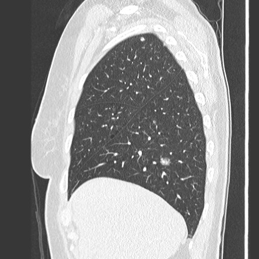 Amyloidosis - bronchial and diffuse nodular pulmonary involvement (Radiopaedia 60156-67745 Sagittal lung window 18).jpg