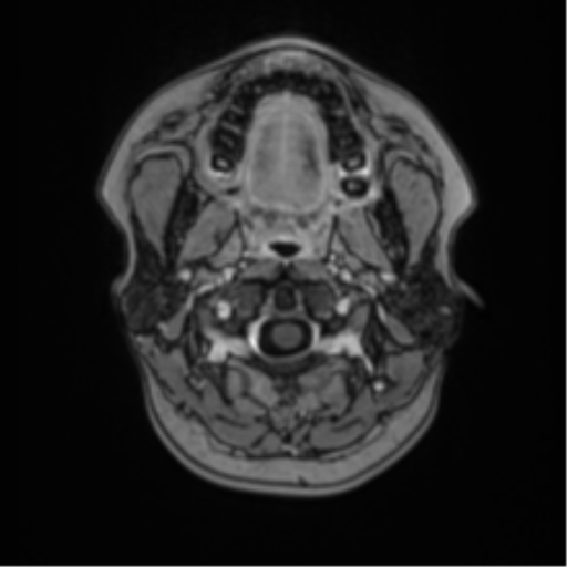 Anaplastic astroblastoma (Radiopaedia 55666-62194 Axial T1 C+ 1).png