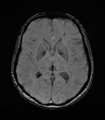 Anaplastic astrocytoma (Radiopaedia 86943-103160 Axial SWI 47).png