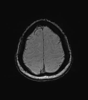 Anaplastic astrocytoma (Radiopaedia 86943-103160 Axial SWI 77).png