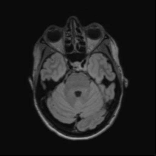File:Anaplastic astrocytoma IDH mutant (Radiopaedia 50046-55341 Axial FLAIR 16).png