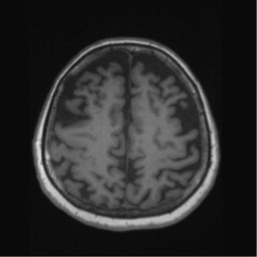 Anaplastic astrocytoma IDH wild-type (pseudoprogression) (Radiopaedia 42209-45276 Axial T1 111).png