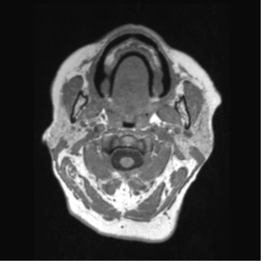 File:Anaplastic astrocytoma IDH wild-type (pseudoprogression) (Radiopaedia 42209-45276 Axial T1 3).png