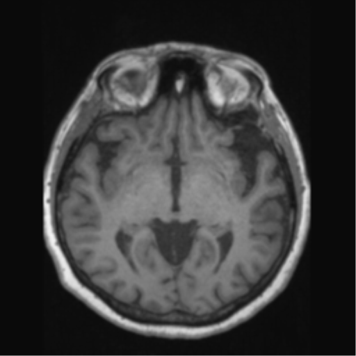 Anaplastic astrocytoma IDH wild-type (pseudoprogression) (Radiopaedia 42209-45276 Axial T1 72).png