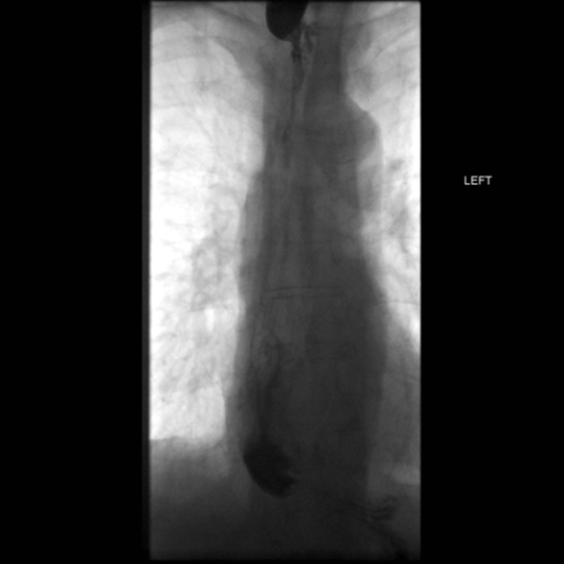 File:Anastomotic stricture post Ivor Lewis esophagectomy (Radiopaedia 47937-52715 B 43).png