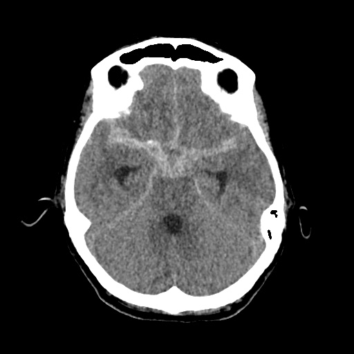 Aneursym related subarachnoid hemorrhage with hydrocephalus (Radiopaedia 45105-49083 Axial non-contrast 14).jpg