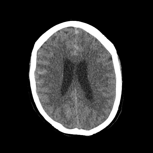 Aneursym related subarachnoid hemorrhage with hydrocephalus (Radiopaedia 45105-49083 Axial non-contrast 31).jpg