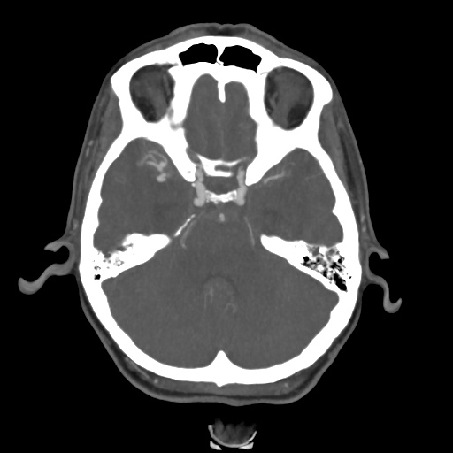 Aneursym related subarachnoid hemorrhage with hydrocephalus (Radiopaedia 45105-49084 A 18).jpg