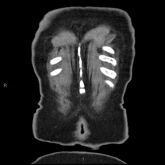 Aneurysm of the inferior vena cava (Radiopaedia 65330-74361 C 98).jpg