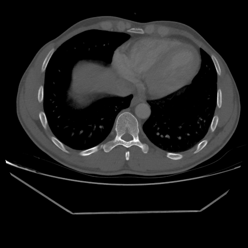 File:Aneurysmal bone cyst - rib (Radiopaedia 82167-96220 Axial bone window 189).jpg