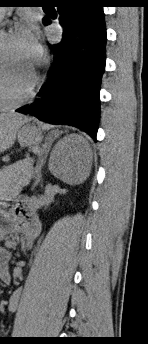 Aneurysmal bone cyst T11 (Radiopaedia 29294-29721 E 15).jpg