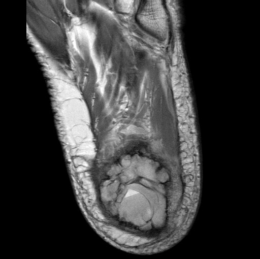 File:Aneurysmal bone cyst of the calcaneus (Radiopaedia 60669-68420 Axial PD 4).jpg