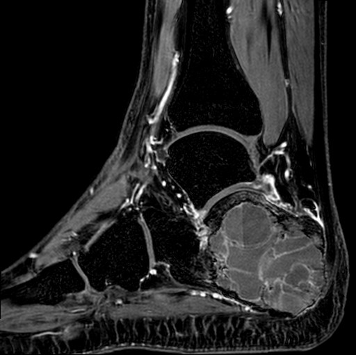 File:Aneurysmal bone cyst of the calcaneus (Radiopaedia 60669-68420 F 19).jpg