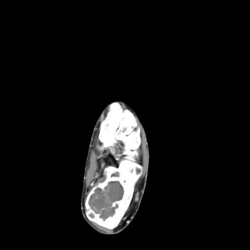 File:Aneurysmal bone cyst of the calcaneus (Radiopaedia 60669-68421 A 27).jpg