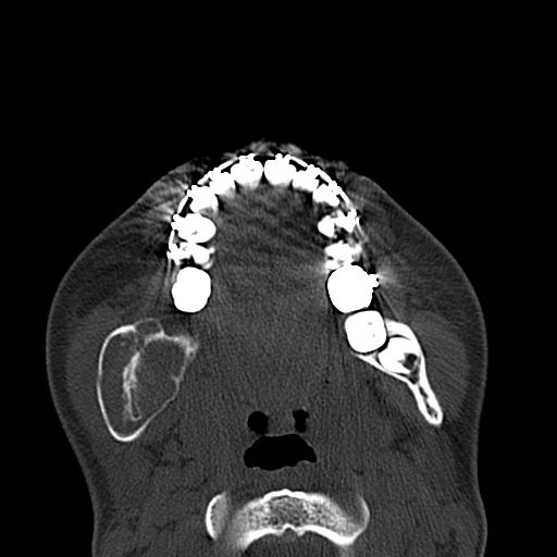 Aneurysmal bone cyst of the mandible (Radiopaedia 43280-46601 Axial bone window 33).jpg