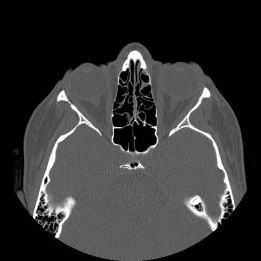 Aneurysmal bone cyst of the mandible (Radiopaedia 43280-46823 Axial bone window 170).jpg