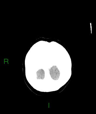 Aneurysmal subarachnoid hemorrhage with intra-axial extension (Radiopaedia 84371-99699 Coronal non-contrast 7).jpg