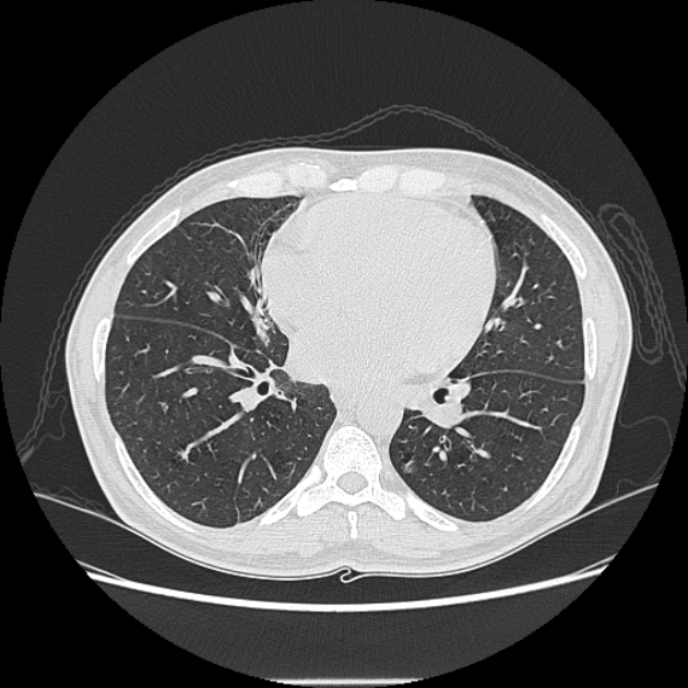 Angioinvasive aspergellosis (Radiopaedia 66995-76315 Axial lung window 30).jpg