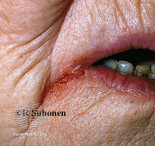 File:Angular cheilitis (DermNet NZ site-age-specific-s-perleche15).jpg