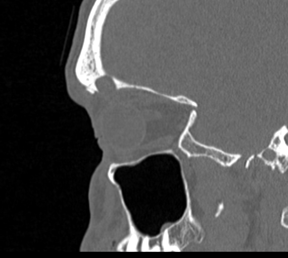 Angular epidermoid cyst (Radiopaedia 46908-51439 Sagittal bone window 69).png