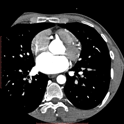 File:Anomalous left coronary artery from the pulmonary artery (ALCAPA) (Radiopaedia 70148-80181 A 140).jpg